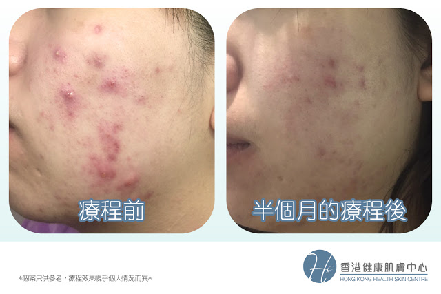 Health Skin 成功個案分享- 3個月擺脫纏擾10年的暗瘡問題I